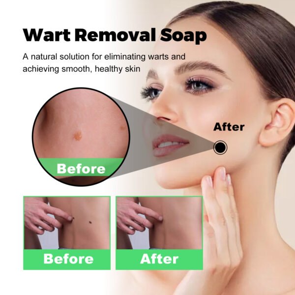 Skin Tag Removal Rubber Band - Image 5