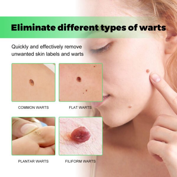 Skin Tag Removal Rubber Band - Image 4