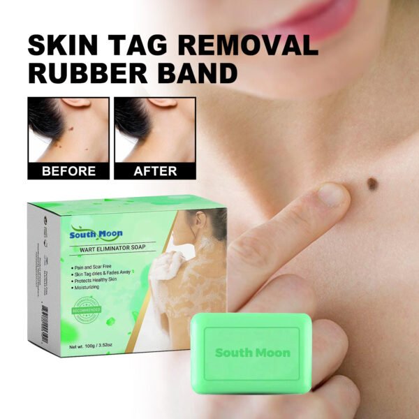 Skin Tag Removal Rubber Band
